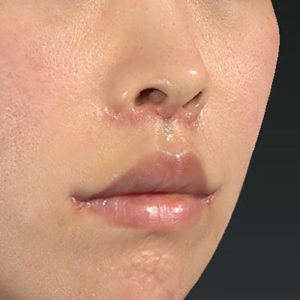 新宿ラクル美容外科クリニック　山本厚志　「人中短縮術（リップリフト）＋口角挙上（スマイルリップ）」　手術後１週間目　４月３日