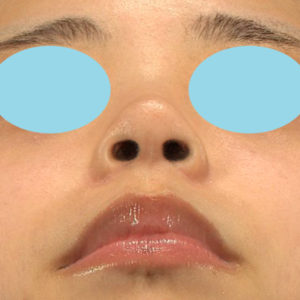 新宿ラクル美容外科クリニック　山本厚志　「小鼻縮小+α法 ＋ 鼻孔縁下降術」　手術後１２ヶ月目　８月１４日