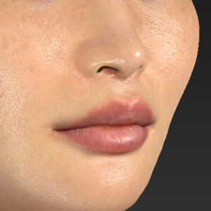 新宿ラクル美容外科クリニック　山本厚志　「人中短縮術（リップリフト）＋口角挙上（スマイルリップ）+小鼻縮小＋α法」　手術後１２ヶ月目　９月２１日