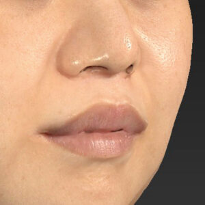 新宿ラクル美容外科クリニック　山本厚志　「人中短縮術（リップリフト）＋口角挙上（スマイルリップ）」　手術後１２ヶ月目　９月２７日