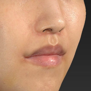 新宿ラクル美容外科クリニック　山本厚志　「人中短縮術（リップリフト）＋口角挙上（スマイルリップ）」　手術後１ヶ月目　３月１７日