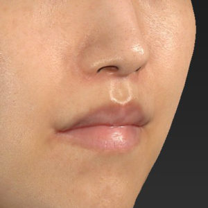 新宿ラクル美容外科クリニック　山本厚志　「人中短縮術（リップリフト）＋口角挙上（スマイルリップ）」　手術後２ヶ月目　３月１７日