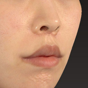新宿ラクル美容外科クリニック　山本厚志　「人中短縮術（リップリフト）＋口角挙上（スマイルリップ）」　手術後２ヶ月目　４月３日