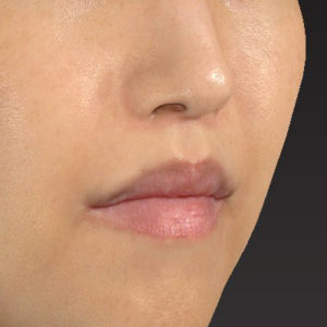 新宿ラクル美容外科クリニック　山本厚志　「人中短縮術（リップリフト）＋口角挙上（スマイルリップ）」　手術後３ヶ月目　４月２１日