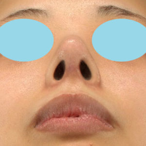 「鼻中隔延長＋耳介軟骨移植＋鼻尖形成＋ワシ鼻修正（ハンプ切除）」　新宿ラクル美容外科クリニック　２０代女性　手術後６ヶ月目　５月１９日