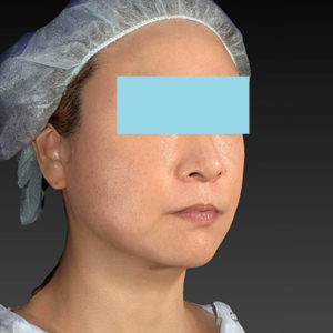 新宿ラクル美容外科クリニック　山本厚志　「アルテミスリフト」　手術後６ヶ月目　５月３１日