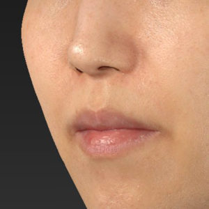 新宿ラクル美容外科クリニック　山本厚志　「人中短縮術（リップリフト）＋口角挙上（スマイルリップ）」　手術前　３月１７日