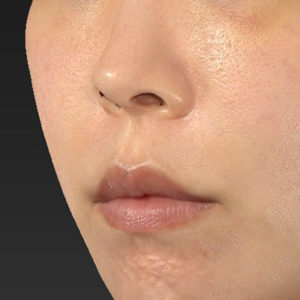 新宿ラクル美容外科クリニック　山本厚志　「人中短縮術（リップリフト）＋口角挙上（スマイルリップ）」　手術前　４月３日