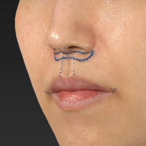 新宿ラクル美容外科クリニック　山本厚志　「人中短縮術（リップリフト）＋口角挙上（スマイルリップ）」　デザイン　３月１７日