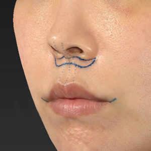 新宿ラクル美容外科クリニック　山本厚志　「人中短縮術（リップリフト）＋口角挙上（スマイルリップ）」　デザイン　４月３日