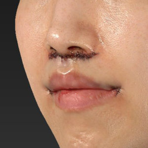 新宿ラクル美容外科クリニック　山本厚志　「人中短縮術（リップリフト）＋口角挙上（スマイルリップ）」　手術直後　３月１７日