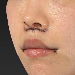 新宿ラクル美容外科クリニック　山本厚志　「人中短縮術（リップリフト）＋口角挙上（スマイルリップ）」　手術直後　４月３日