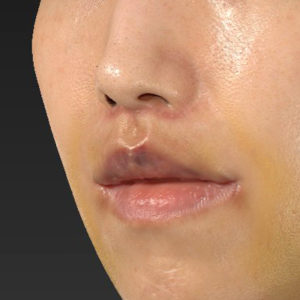 新宿ラクル美容外科クリニック　山本厚志　「人中短縮術（リップリフト）＋口角挙上（スマイルリップ）」　手術後１週間目　３月１７日