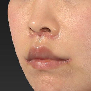新宿ラクル美容外科クリニック　山本厚志　「人中短縮術（リップリフト）＋口角挙上（スマイルリップ）」　手術後１週間目　４月３日