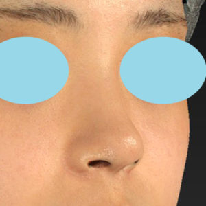 新宿ラクル美容外科クリニック　山本厚志　「小鼻縮小+α法 ＋ 鼻孔縁下降術」　手術後１２ヶ月目　８月１４日