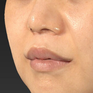 新宿ラクル美容外科クリニック　山本厚志　「人中短縮術（リップリフト）＋口角挙上（スマイルリップ）」　手術後１２ヶ月目　９月２７日