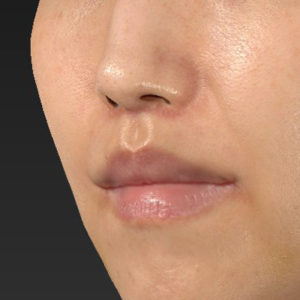 新宿ラクル美容外科クリニック　山本厚志　「人中短縮術（リップリフト）＋口角挙上（スマイルリップ）」　手術後１ヶ月目　３月１７日