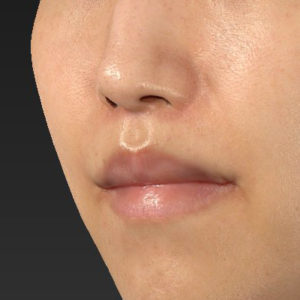 新宿ラクル美容外科クリニック　山本厚志　「人中短縮術（リップリフト）＋口角挙上（スマイルリップ）」　手術後２ヶ月目　３月１７日