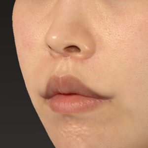 新宿ラクル美容外科クリニック　山本厚志　「人中短縮術（リップリフト）＋口角挙上（スマイルリップ）」　手術後２ヶ月目　４月３日
