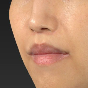 新宿ラクル美容外科クリニック　山本厚志　「人中短縮術（リップリフト）＋口角挙上（スマイルリップ）」　手術後３ヶ月目　４月２１日
