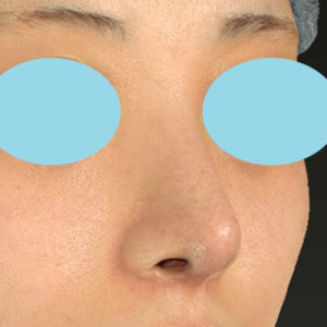 「鼻中隔延長＋耳介軟骨移植＋鼻尖形成＋ワシ鼻修正（ハンプ切除）」　新宿ラクル美容外科クリニック　２０代女性　手術後６ヶ月目　５月１９日