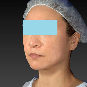 新宿ラクル美容外科クリニック　山本厚志　「アルテミスリフト」　手術後６ヶ月目　５月３１日