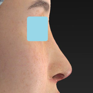 「鼻中隔延長(鼻中隔軟骨)＋耳介軟骨移植 修正＋鼻尖形成 修正＋猫手術＋鼻プロテーゼ入れ替え」　新宿ラクル美容外科クリニック　２０代女性　手術後１週間目　７月１８日