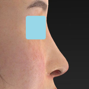 「鼻中隔延長(鼻中隔軟骨)＋耳介軟骨移植 修正＋鼻尖形成 修正＋猫手術＋鼻プロテーゼ入れ替え」　新宿ラクル美容外科クリニック　２０代女性　手術後２週間目　７月１８日