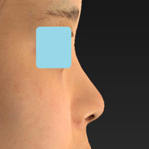 新宿ラクル美容外科クリニック　山本厚志　「小鼻縮小+α法 ＋ 鼻孔縁下降術」　手術後１２ヶ月目　８月１４日