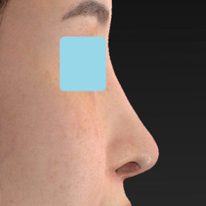 「鼻中隔延長(鼻中隔軟骨)＋耳介軟骨移植 修正＋鼻尖形成 修正＋猫手術＋鼻プロテーゼ入れ替え」　新宿ラクル美容外科クリニック　２０代女性　手術後２ヶ月目　７月１８日