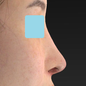 「鼻中隔延長(鼻中隔軟骨)＋耳介軟骨移植 修正＋鼻尖形成 修正＋猫手術＋鼻プロテーゼ入れ替え」　新宿ラクル美容外科クリニック　２０代女性　手術後３ヶ月目　８月１２日