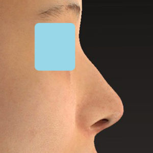 「鼻中隔延長＋耳介軟骨移植＋鼻尖形成＋ワシ鼻修正（ハンプ切除）」　新宿ラクル美容外科クリニック　２０代女性　手術後６ヶ月目　５月１９日