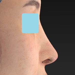 「鼻中隔延長(鼻中隔軟骨)＋耳介軟骨移植 修正＋鼻尖形成 修正＋猫手術＋鼻プロテーゼ入れ替え」　新宿ラクル美容外科クリニック　３０代女性　手術後６ヶ月目　１２月１８日