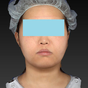 新宿ラクル美容外科クリニック　山本厚志　「ライポライフ脂肪吸引（ジョールファット+あご下）」　手術後１ヶ月目　４月２３日