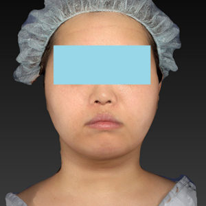 新宿ラクル美容外科クリニック　山本厚志　「ライポライフ脂肪吸引（ジョールファット+あご下）」　手術後２ヶ月目　４月２３日