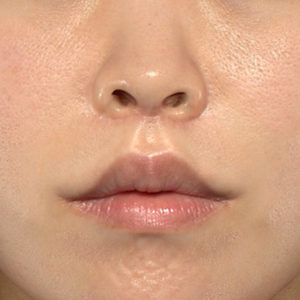 新宿ラクル美容外科クリニック　山本厚志　「人中短縮術（リップリフト）＋口角挙上（スマイルリップ）」　手術後３ヶ月目　４月２９日
