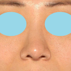 「鼻中隔延長（鼻中隔軟骨）＋耳介軟骨移植＋鼻尖形成＋真皮脂肪移植（鼻尖）＋猫手術」　新宿ラクル美容外科クリニック　３０代女性　手術後３ヶ月目　５月２０日