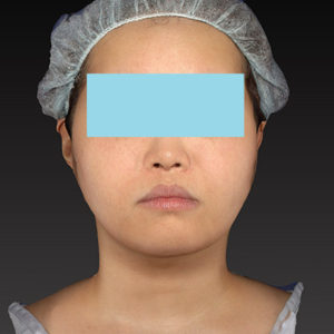 新宿ラクル美容外科クリニック　山本厚志　「ライポライフ脂肪吸引（ジョールファット+あご下）」　手術後３ヶ月目　５月２４日