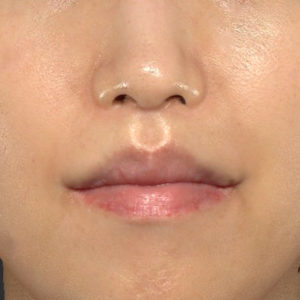 新宿ラクル美容外科クリニック　山本厚志　「人中短縮術（リップリフト）＋口角挙上（スマイルリップ）」　手術後６ヶ月目　７月２１日