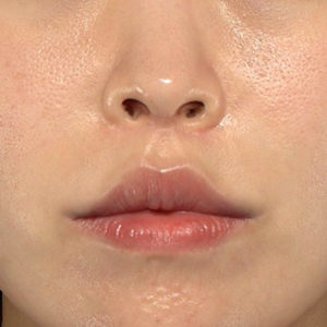 新宿ラクル美容外科クリニック　山本厚志　「人中短縮術（リップリフト）＋口角挙上（スマイルリップ）」　手術後６ヶ月目　８月１０日