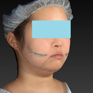 新宿ラクル美容外科クリニック　山本厚志　「ライポライフ脂肪吸引（ジョールファット+あご下）」　デザイン　４月２３日