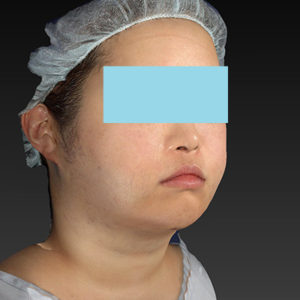 新宿ラクル美容外科クリニック　山本厚志　「ライポライフ脂肪吸引（ジョールファット+あご下）」　手術直後　４月２３日