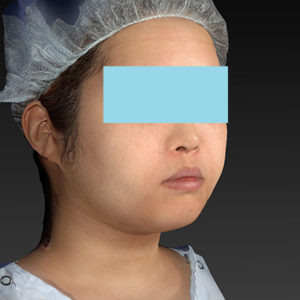 新宿ラクル美容外科クリニック　山本厚志　「ライポライフ脂肪吸引（ジョールファット+あご下）」　手術後１週間目　４月２３日