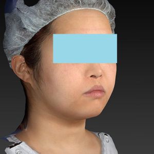 新宿ラクル美容外科クリニック　山本厚志　「ライポライフ脂肪吸引（ジョールファット+あご下）」　手術後１ヶ月目　４月２３日