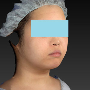 新宿ラクル美容外科クリニック　山本厚志　「ライポライフ脂肪吸引（ジョールファット+あご下）」　手術後２ヶ月目　４月２３日