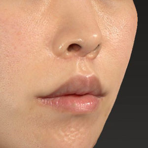 新宿ラクル美容外科クリニック　山本厚志　「人中短縮術（リップリフト）＋口角挙上（スマイルリップ）」　手術後３ヶ月目　４月２９日
