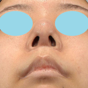 「鼻中隔延長＋耳介軟骨移植＋鼻尖形成＋猫手術＋貴族手術＋鼻骨骨切り幅寄せ」　新宿ラクル美容外科クリニック　２０代女性　手術後６ヶ月目　４月３０日