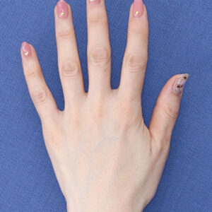 新宿ラクル美容外科クリニック　山本厚志　「手の若返り（プレミアムPRP×FGF皮膚再生療法）」　治療後６ヶ月目　１０月８日