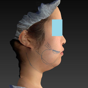 新宿ラクル美容外科クリニック　山本厚志　「ライポライフ脂肪吸引（ジョールファット+あご下）」　デザイン　４月２３日