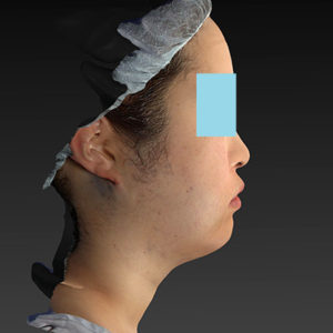 新宿ラクル美容外科クリニック　山本厚志　「ライポライフ脂肪吸引（ジョールファット+あご下）」　手術直後　４月２３日